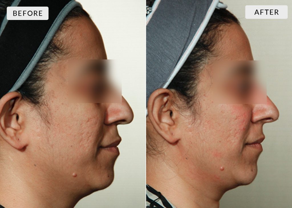 Anti Wrinkle Treatment in Delhi | Botox Treatment in Delhi | Dr Reema Arora