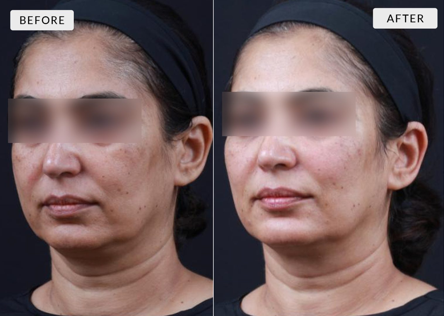Cheek Augmentation Delhi - Dr Reema Arora - The Face Clinic