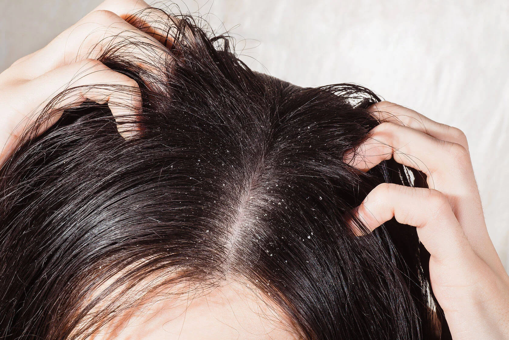 Skin Specialist 5 effective home remedies to get rid of dandruff