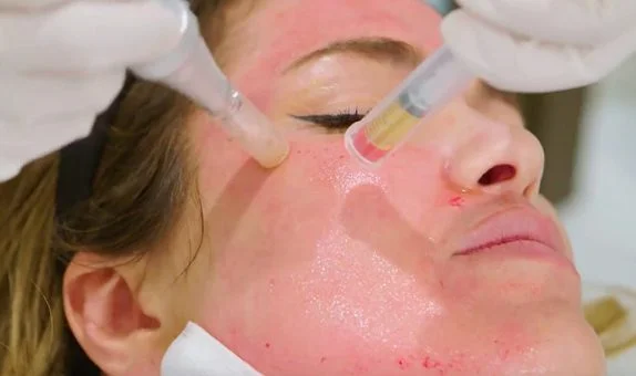 Vampire Facial Cost in Delhi | Vampire Facial Treatment in India #1
