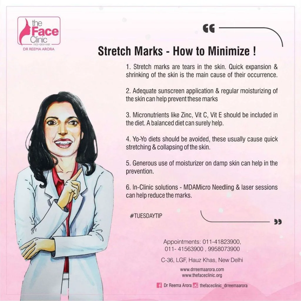 Stretch marks - How To Minimize