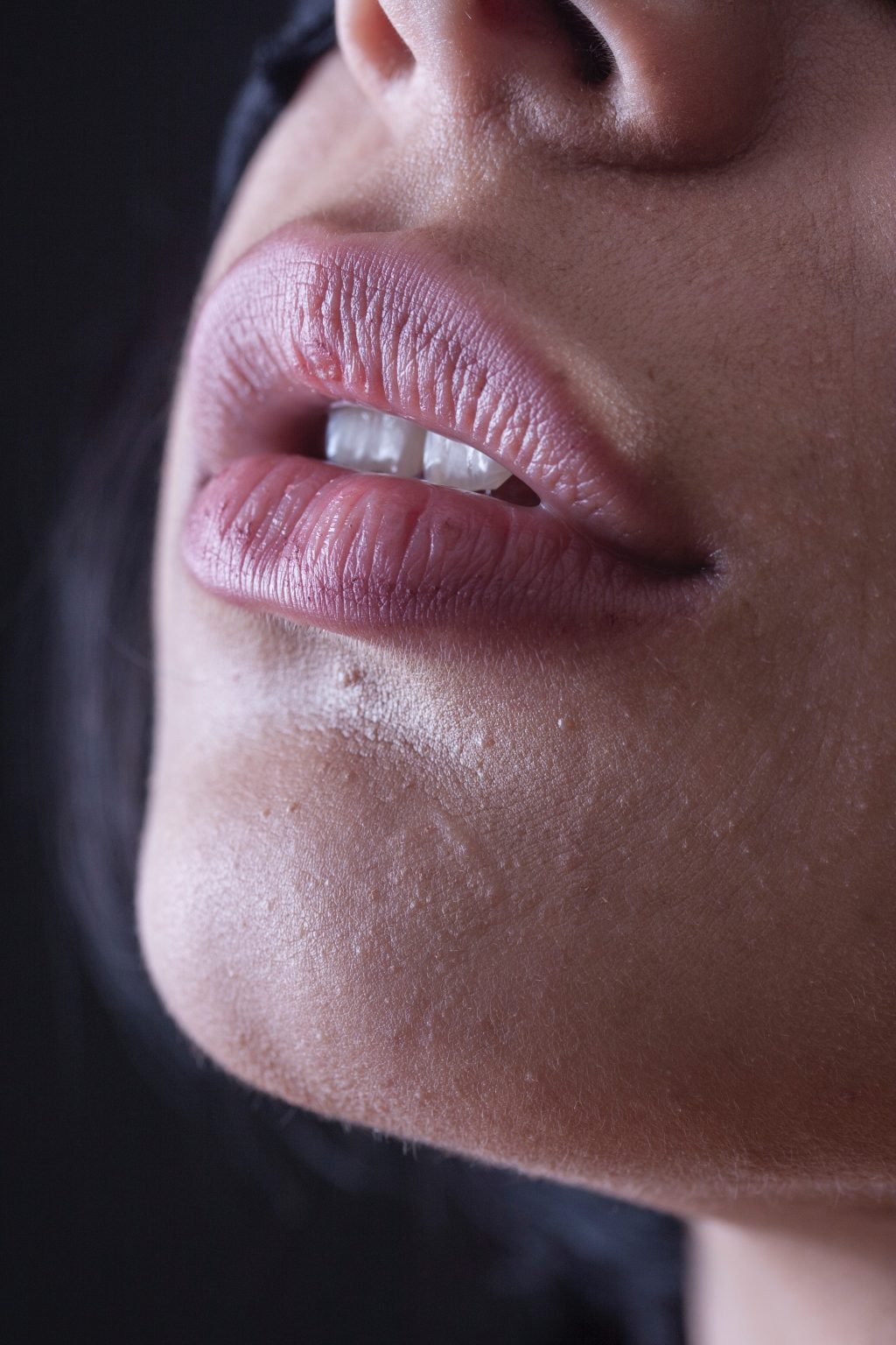 Lip Fillers Cost in India | #Lip Augmentation | Best Lip Filler in Delhi