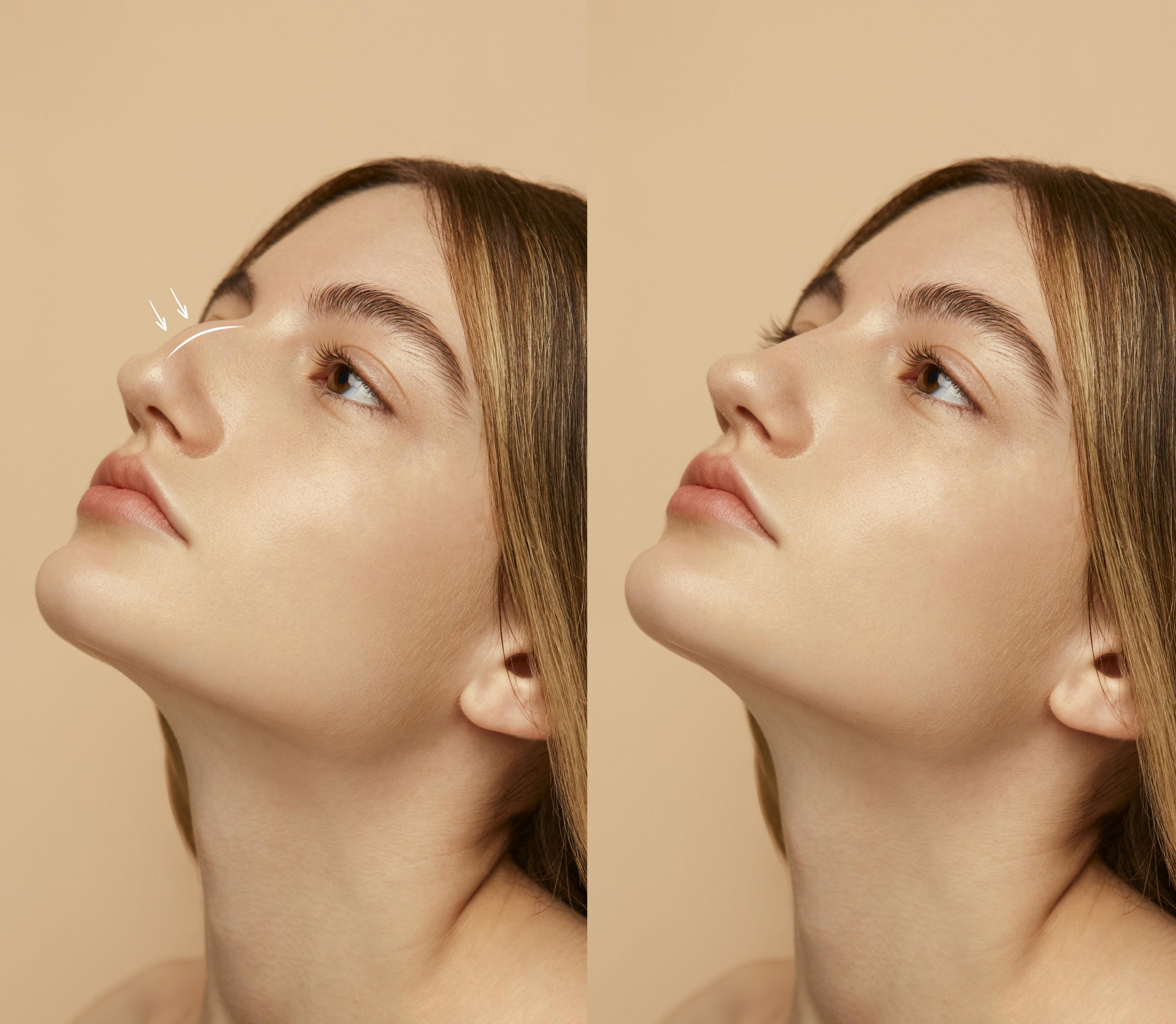 Best Nose Fillers Cost in Delhi | Non Surgical Rhinoplasty in India