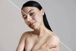 Best Acne Scar Treatment Doctor Clinic in Delhi | Acne Scar Removal in Delhi