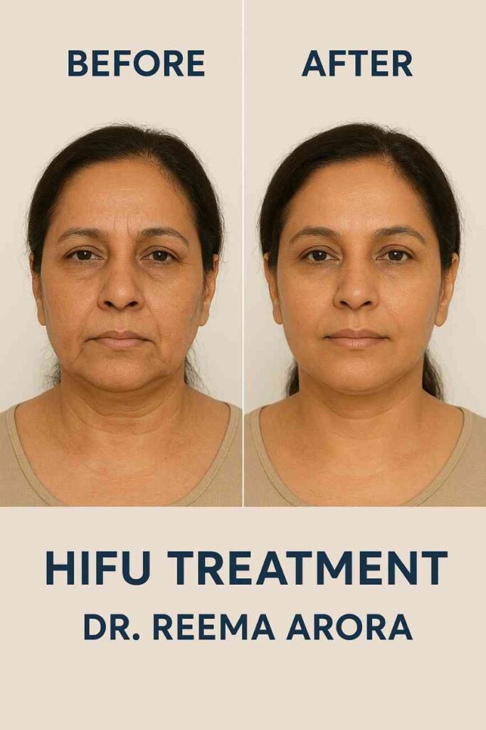Before and after HIFU treatment results in Delhi.
