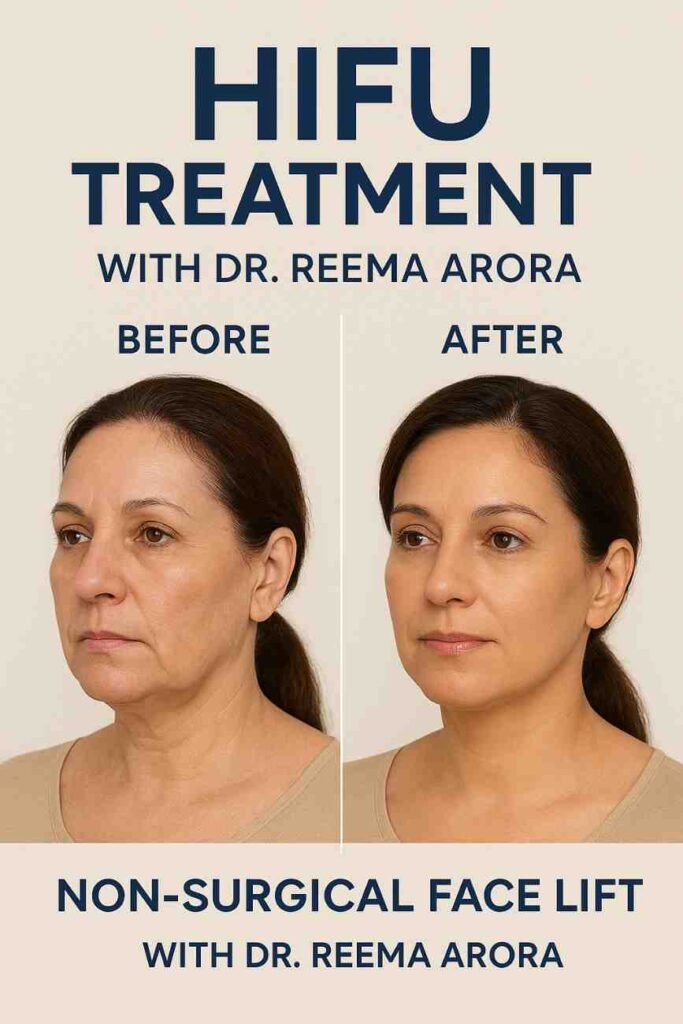 Hifu Face Lift Before After India