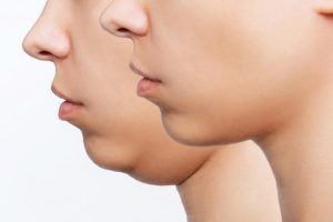Best Double Chin Treatment in Delhi Non Invasive Double Chin Removal in India