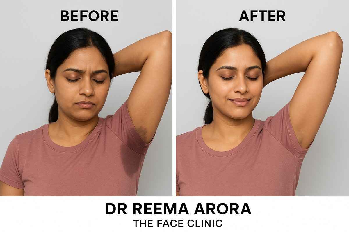 Before and after results of hyperhidrosis treatment on an Indian woman by Dr. Reema Arora at The Face Clinic.