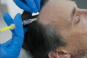 Polynucleotide Treatment for Hair Loss in Delhi, India | Advanced Hair Restoration