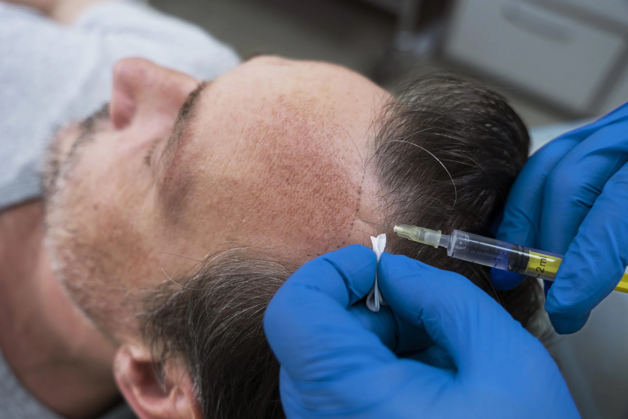 Mesotherapy 1 Doctor performing advanced mesotherapy treatment on female patient for skin rejuvenation, hydration, collagen stimulation, and anti-aging benefits in a clinical setting in Delhi.