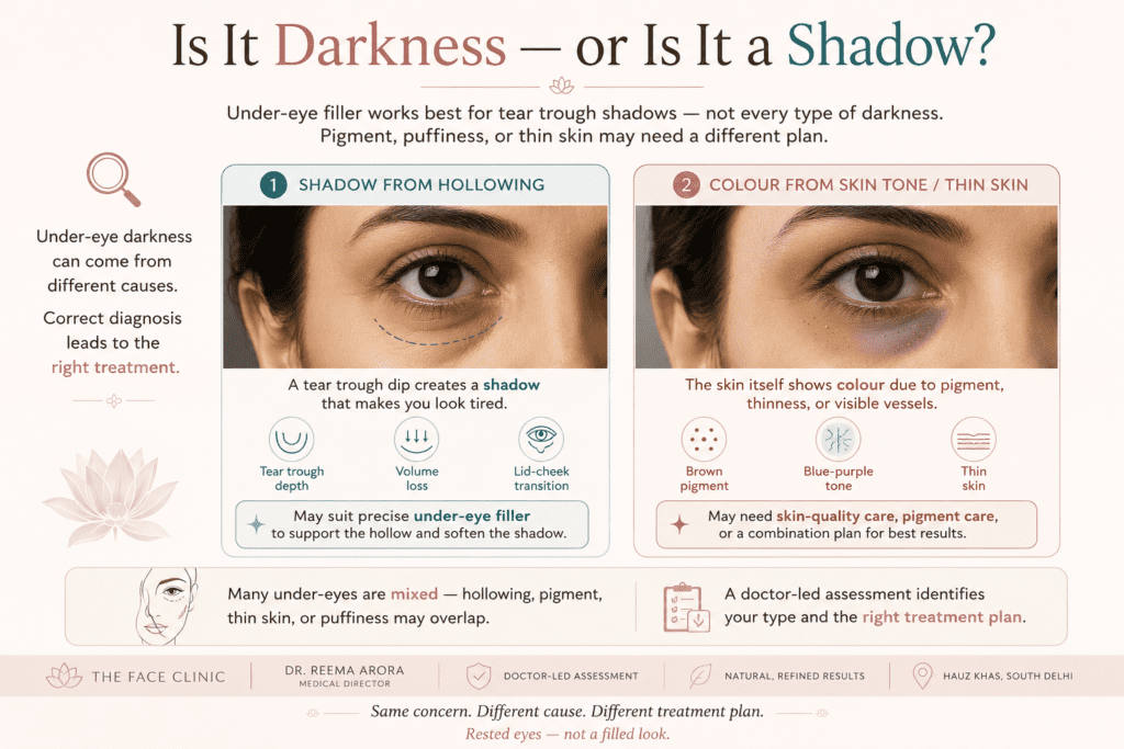 Educational under-eye filler visual explaining the difference between tear trough shadow, pigmentation, thin skin, puffiness, and mixed under-eye concerns before doctor-led treatment planning at The Face Clinic, Hauz Khas, South Delhi.