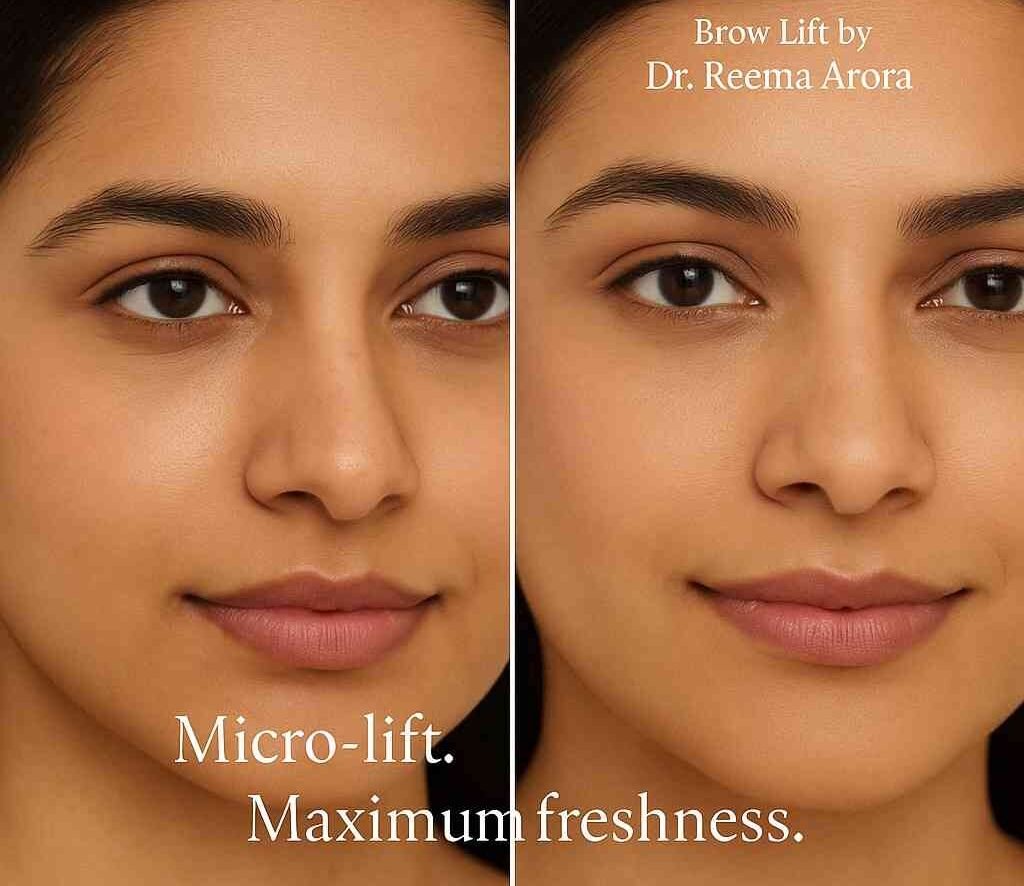 Eyebrow lift aesthetic treatment