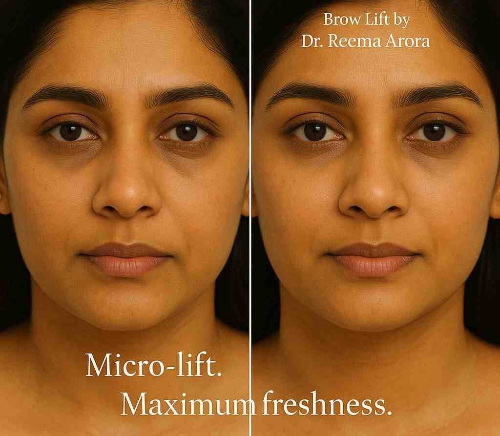 Patient undergoing eyebrow lift procedure