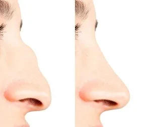 How Fillers Can Enhance Your Nose Without Surgery | Non-Surgical Nose Job in Delhi