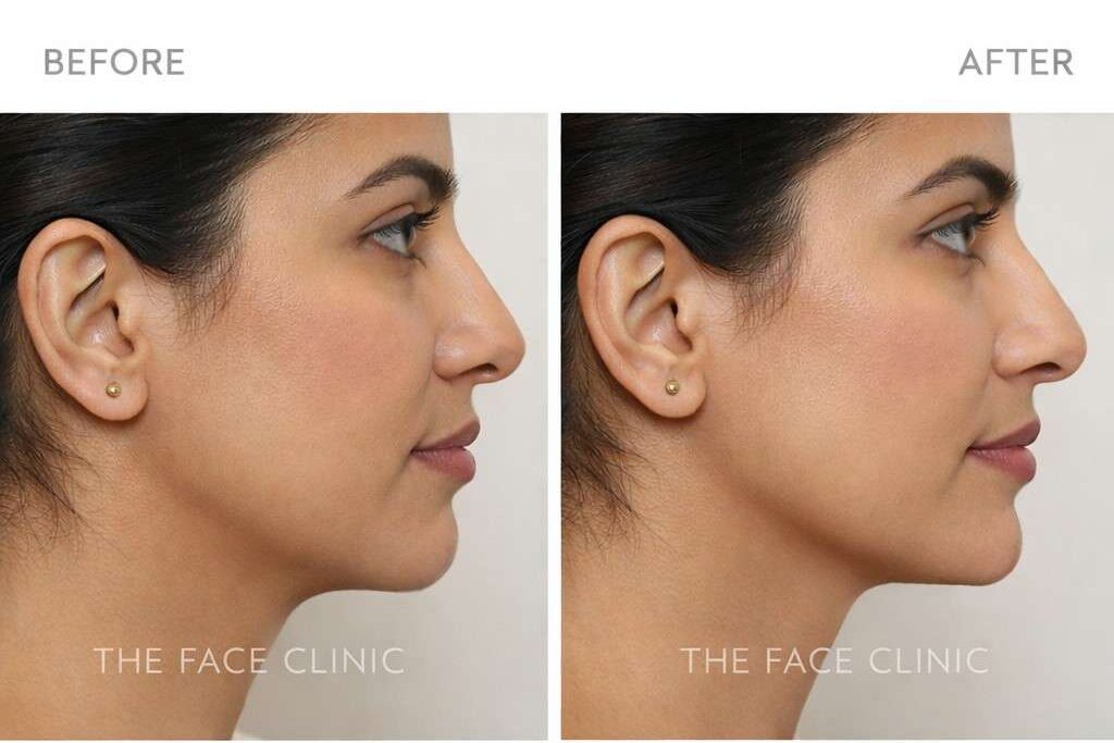 Dermal fillers before and after jawline and chin enhancement Delhi natural looking results