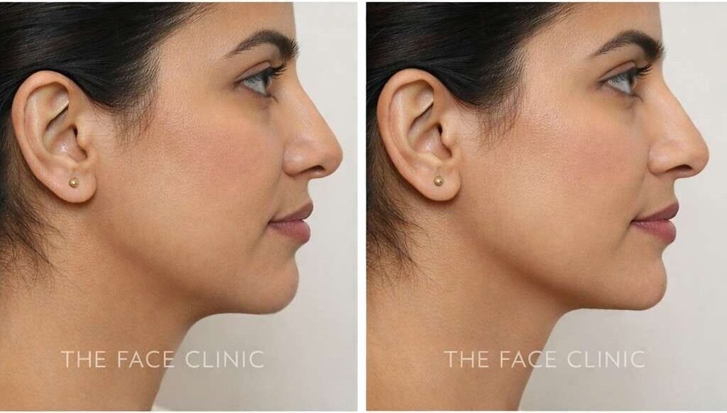 Illustration of chin and jawline areas assessed before dermal filler treatment
