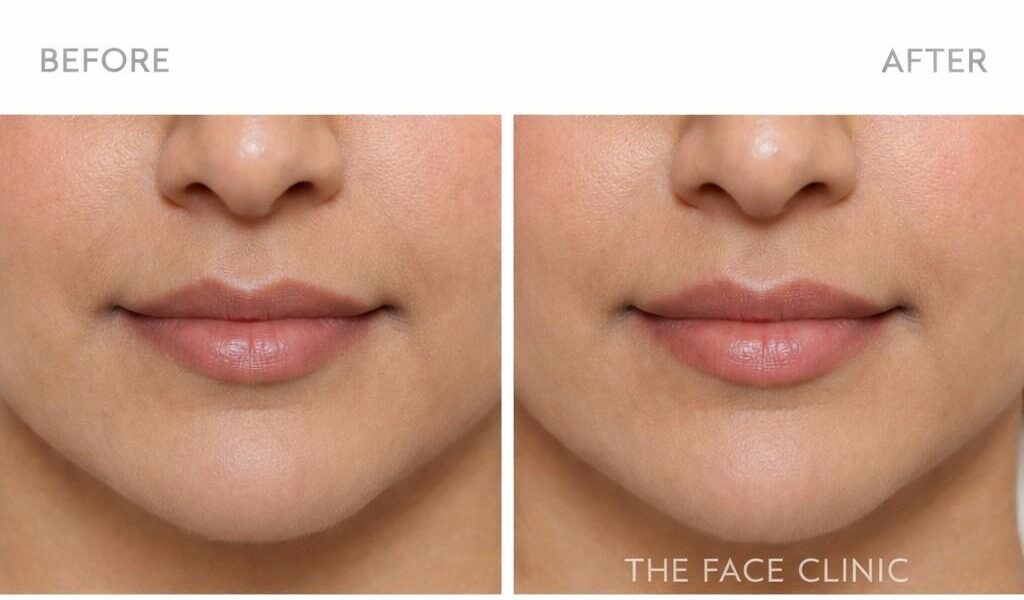 Natural lip dermal fillers before and after Delhi subtle lip enhancement results