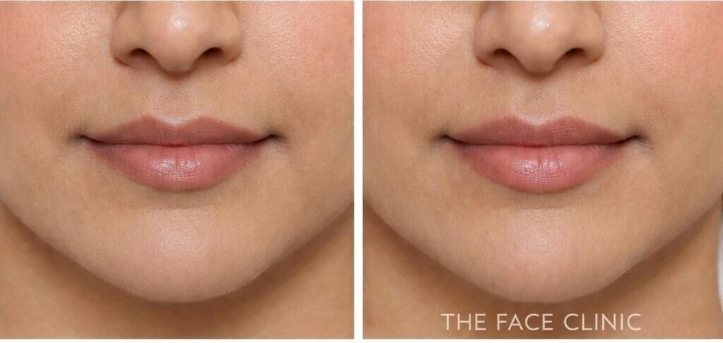 Illustration of lip shape and proportion assessed before lip filler treatment