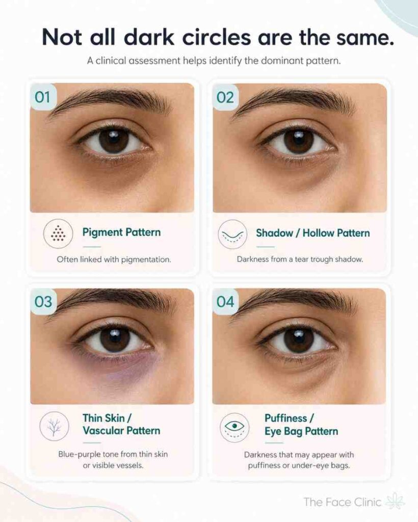 Dark Circles Treatment – Dr Reema Arora
